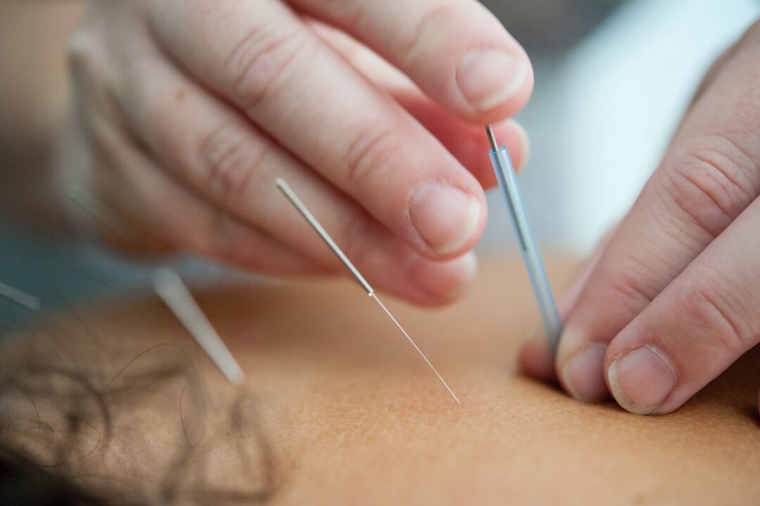 Acupuncture is an ineffective way to give up smoking